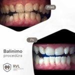 RVL dantų balinimas - odontologijos paslaugos Vilniuje ir Panevėžyje