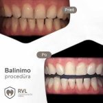RVL dantų balinimas - odontologijos paslaugos Vilniuje ir Panevėžyje